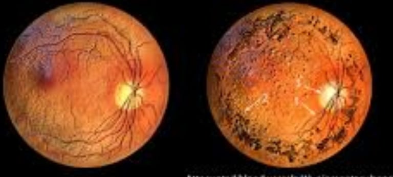 retinitis pigmentosa