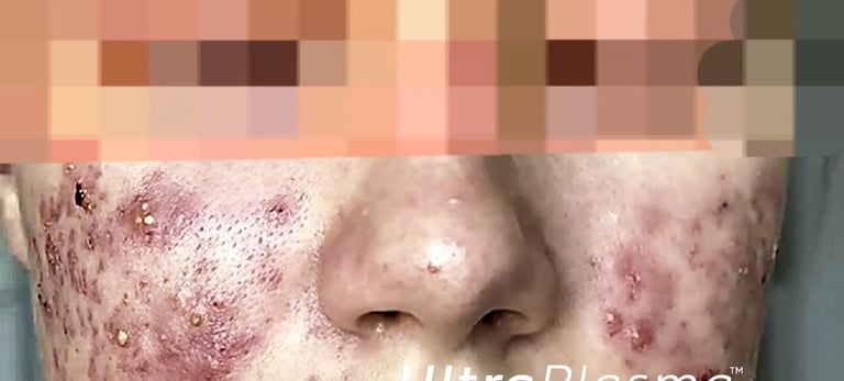 akne_acne_ultra_plasma_ultra_plazma_ultra-plasma_ultra-plazma