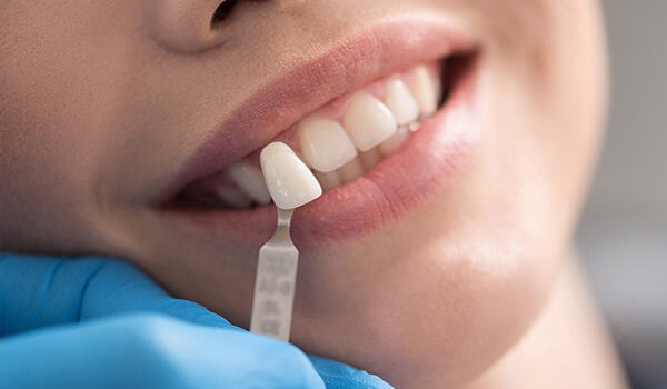 Best Veneers Laminates Treatments Clinic in Pune 
