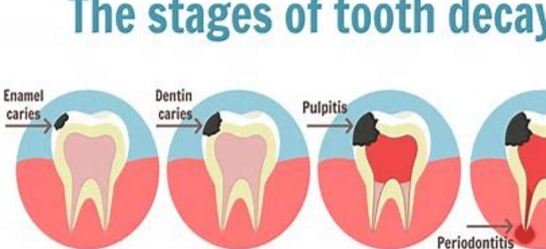tooth caries 