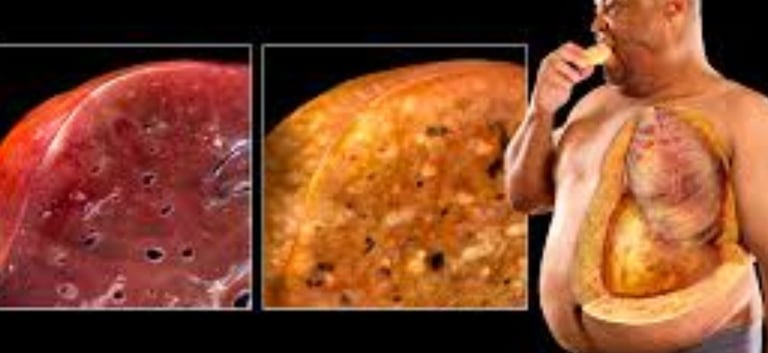 fatty liver more in obese patient