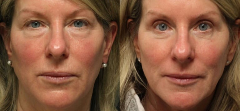 upper eyelid surgery Antalya plastic surgeon