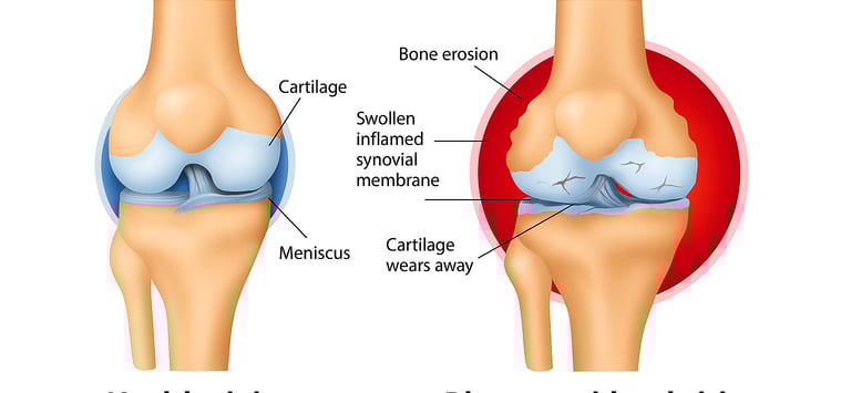 Diagram showing rheumatoid arthritis on knee joint- before and after causing RA.