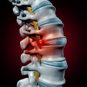Illustration of spinal canal narrowing in lumber spinal stenosis.