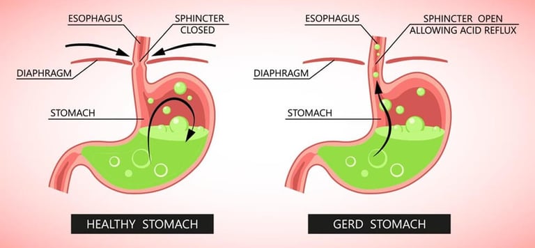 GERD stomach