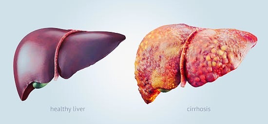 lever cirrhosis