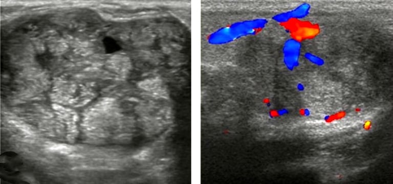 Ultrasound images of breast masses using color Doppler for hands-on training classes.