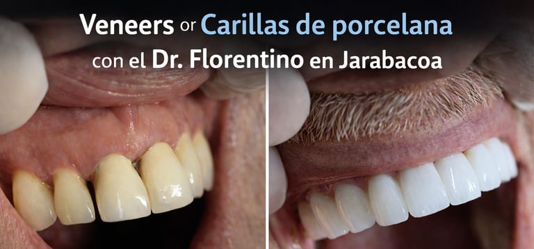 Veneers o Carillas de Porcelana Con el Dr.Florentino en Jarabacoa