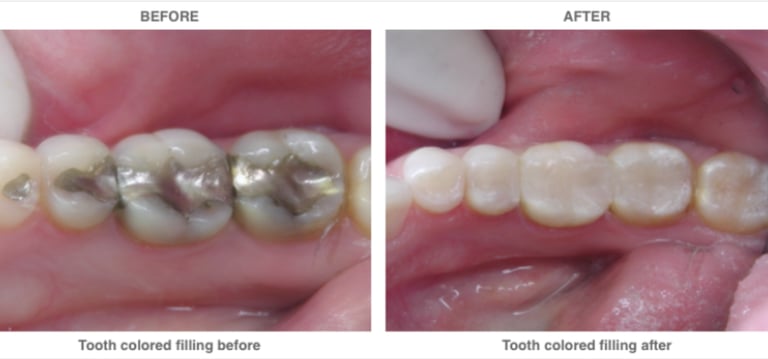 before and after - removal of amalgam fillings