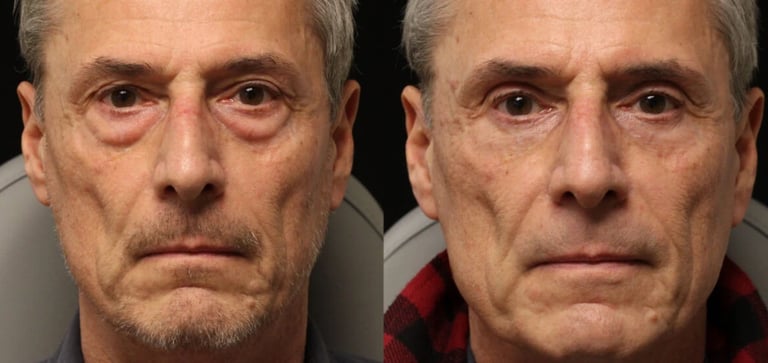 blepharoplasty before after Dr Altan Tekin Antalya