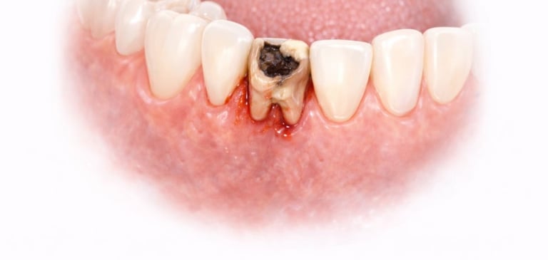 illustration showing milk tooth between permanent teeth at shree dental care near shyamal