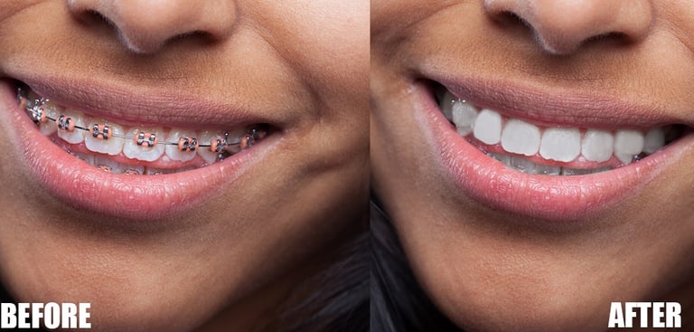 Filipino-Photo-Editor-Brace-Removal-two