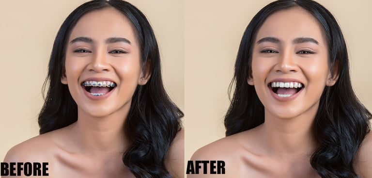 brace-removal
