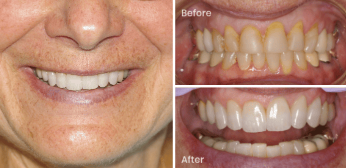 Women with Weneers before and after