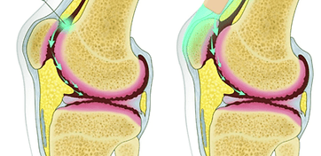 Dr.Rajinikanth's ortho clinic intra articular glucosamine