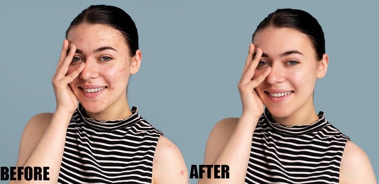 pimple-or-acne-removal