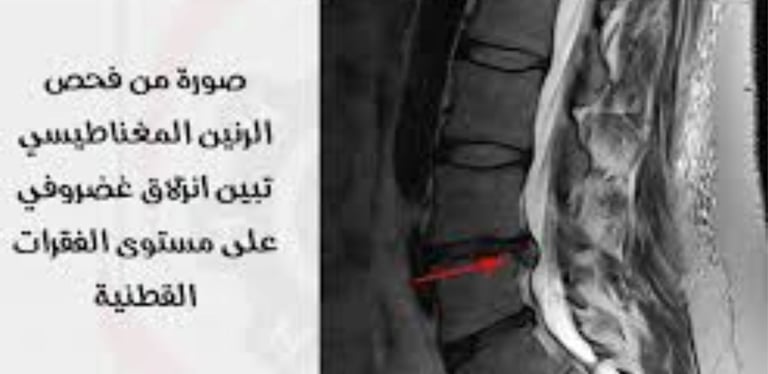 herniated disc,disc herniation,bulging disc,herniated disc surgery
