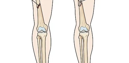 v femur shaft fracture
