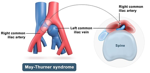 vascular ultrasound may thurner syndrome iliac vein common artery compression deep vein thrombosis swelling leg pain pelvic