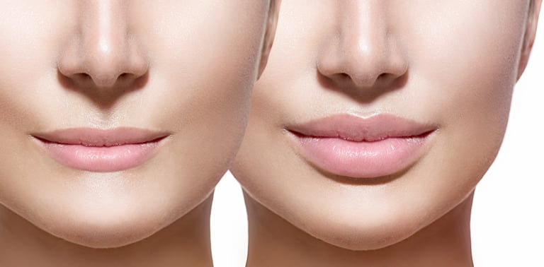 Buze injectate cu acid hialuronic