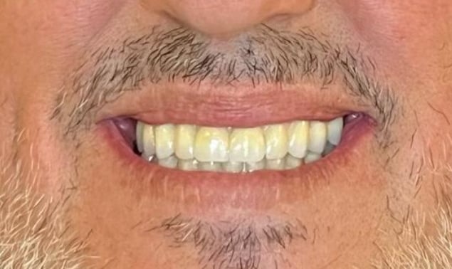 Procad Henares , rehabilitación circonio