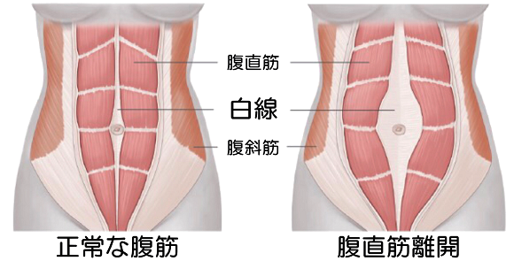 腹直筋離開