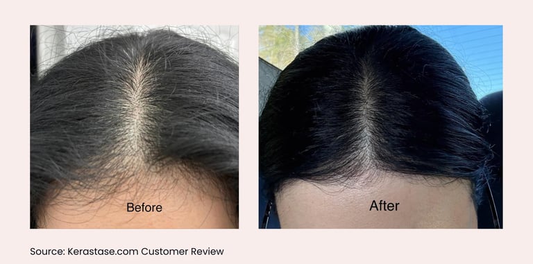 Visible reduction in scalp visibility and thicker hair part after consistent application of Aminexil