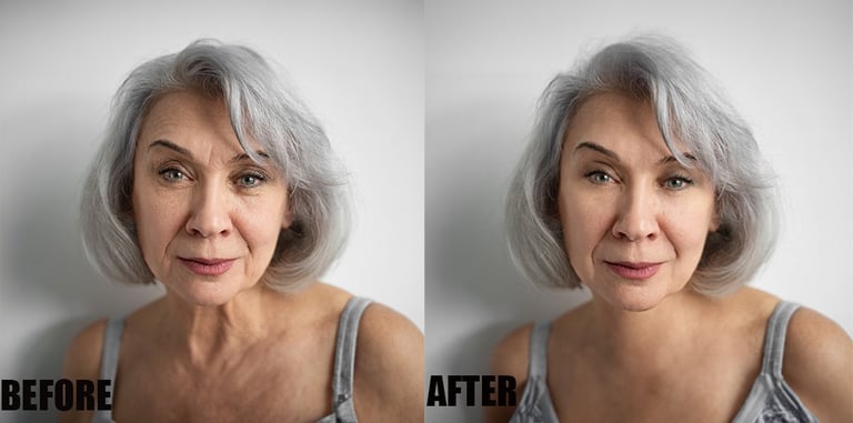 wrinkle-or-scar-marks-removal