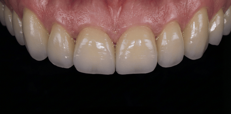 Close-up of a patient with natural-looking dental crowns and healthy pink gums.
