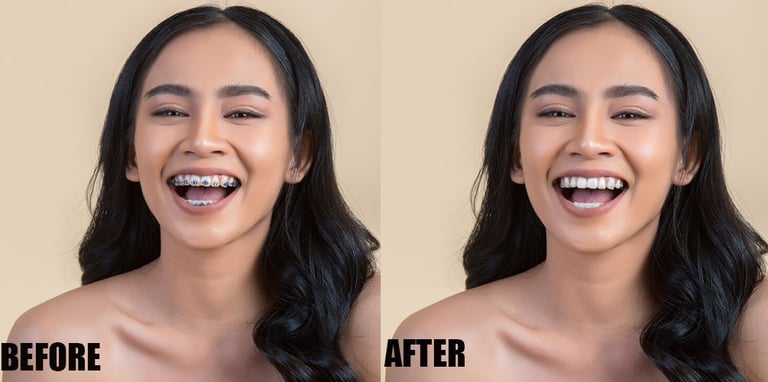 brace-removal