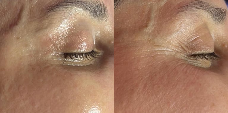 Comparaison avant et après en gros plan de la peau d’un client, montrant une amélioration visible de