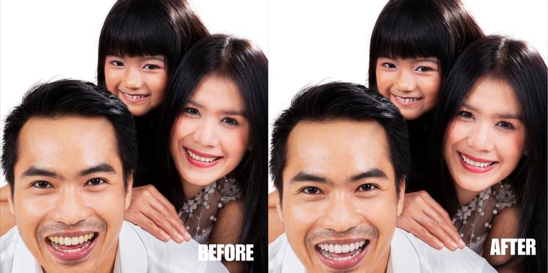 teeth-whitening