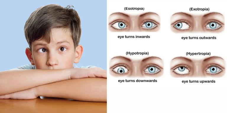 Strabismus, commonly called as squint or crossed eyes, is a condition where the eyes are not properly aligned.