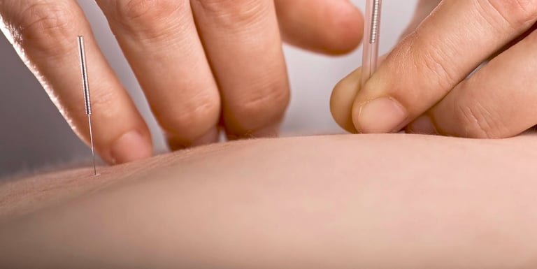 Acupuncture