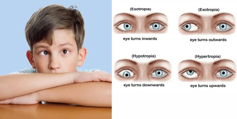 Strabismus, commonly called as squint or crossed eyes, is a condition where the eyes are not properly aligned.