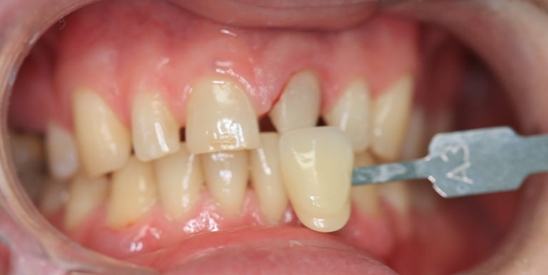 Sostituzione Incisivo Centrale, caso clinico