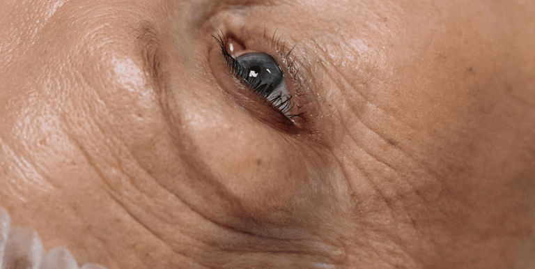 Blefaroplastia