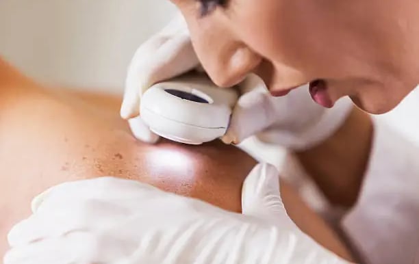 a woman getting a laser tattoo on her back