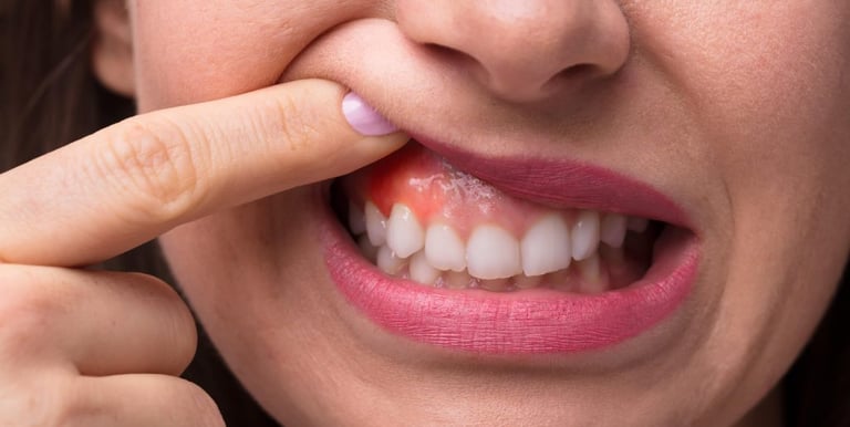 Tratamento e prevenção periodontal em Curitiba para gengivas saudáveis e livres de inflamação.