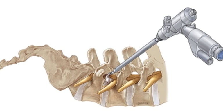 Foto esquemática mostrando uma endoscopia de coluna lombar. 
