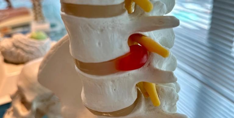 Cirurgia da coluna realizada por neurocirurgião em Fortaleza