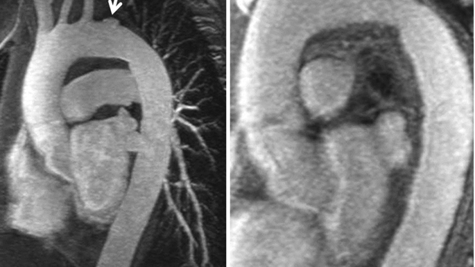 Pericardcheck aortic