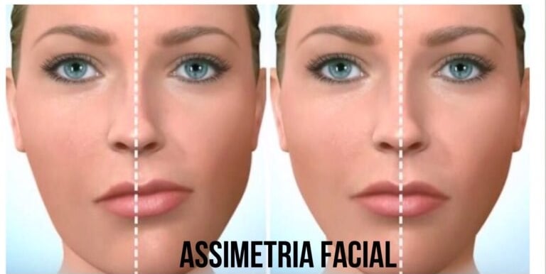 Assimetria facial 