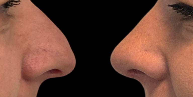 rinoplastika-prije-poslije-dr-marjanovic-kavanagh