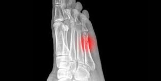 Dr.Rajinikanth's ortho clinic stress fratures