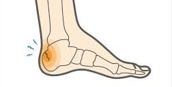 Dr.Rajinikanth's ortho clinic heel fracture