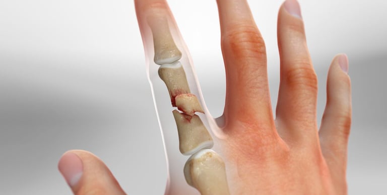 Dr.Rajinikanth's ortho clinic finger fracture