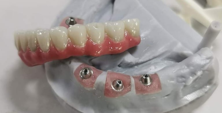 A case of All-on-4 full arch implant denture