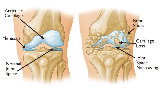 best knee replacement surgeon in bangalore