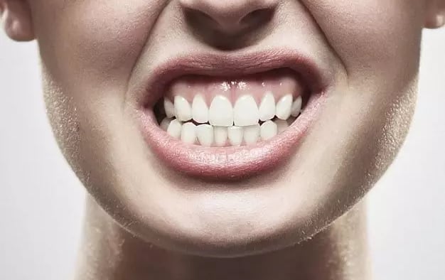 Tratamento para bruxismo em Curitiba com placa de proteção e acompanhamento odontológico.
